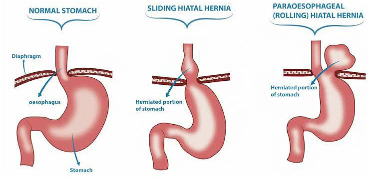 Hiatal Hernia