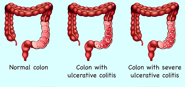 Ulcerative Colitis