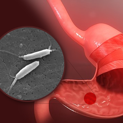 Helicobacter Pylori Gastritis